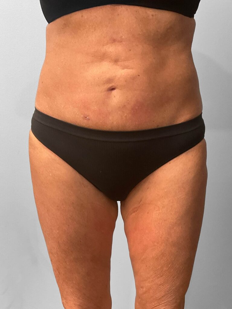 Before Image: Emsculpt Neo – Renewal Med Spa - front