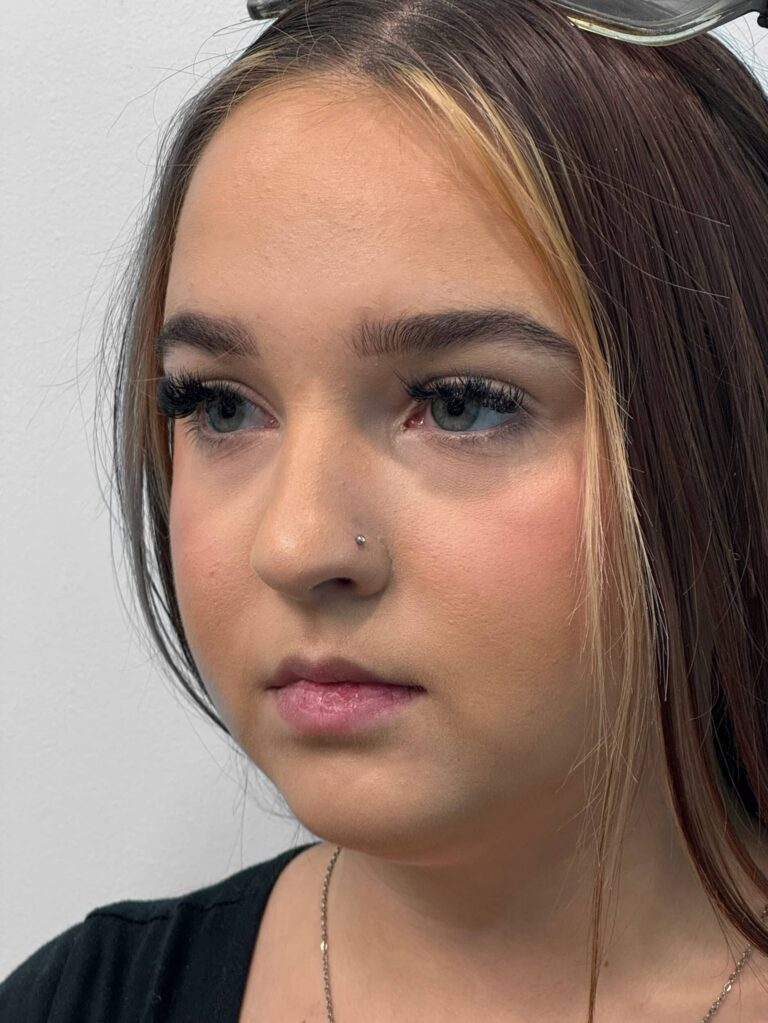Before Image: Juvederm – Joy - left-front-oblique