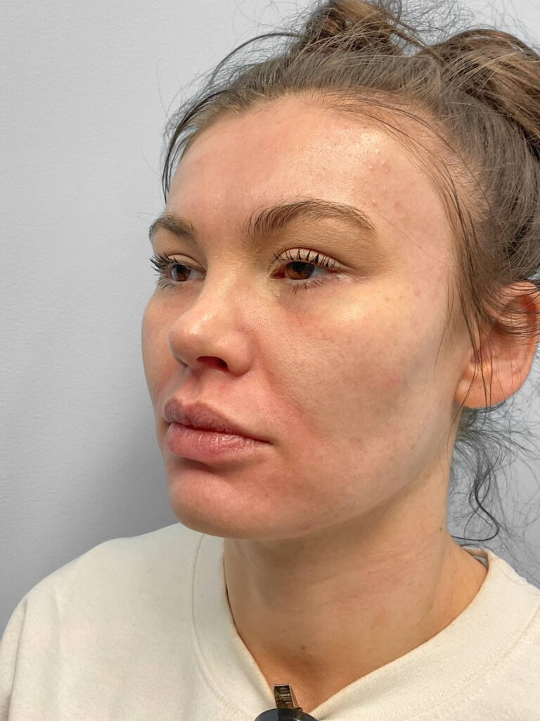 Before Image: Juvederm – Heather - left-front-oblique