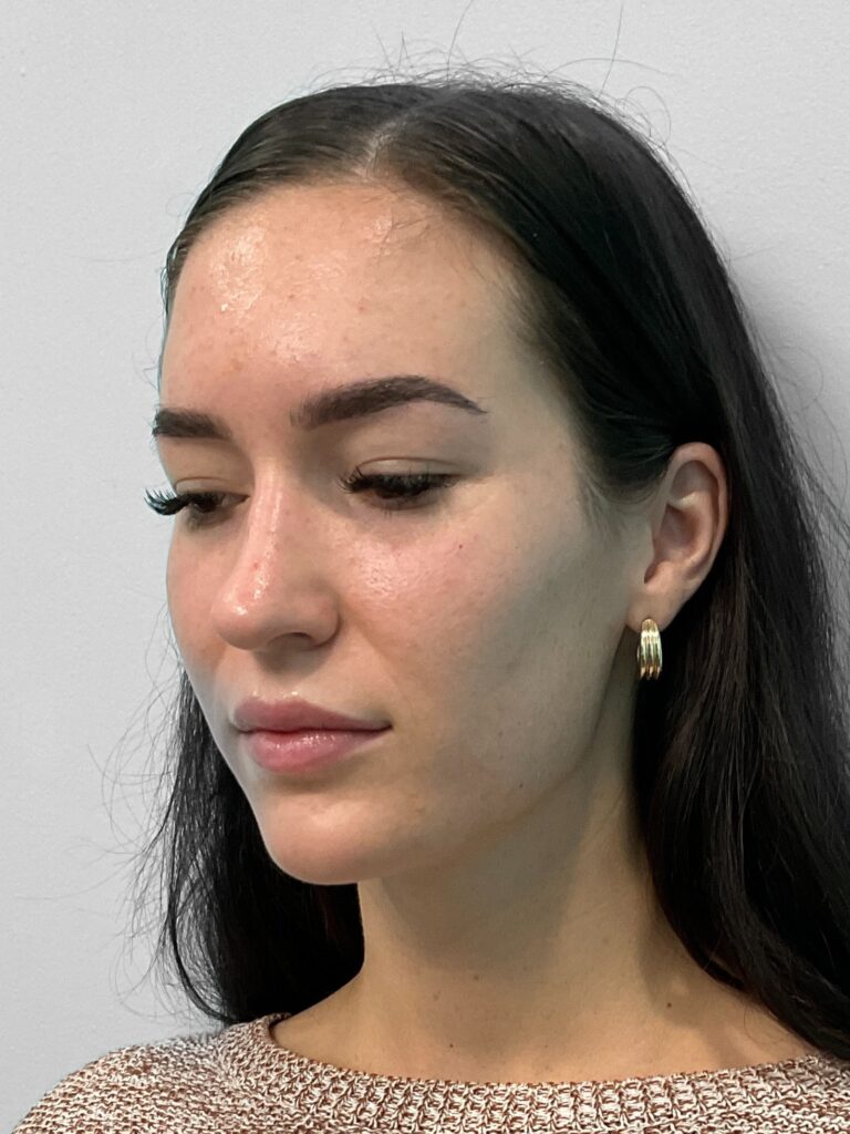 Before Image: Juvederm – Joy - left-front-oblique