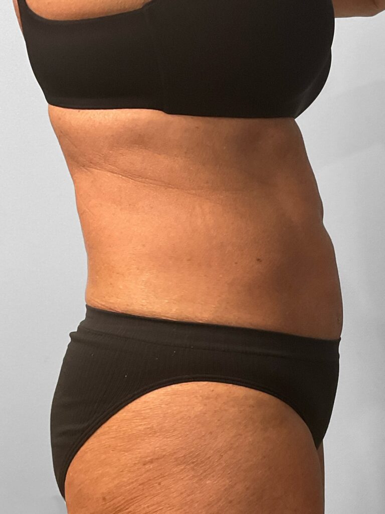 Before Image: Emsculpt Neo – Renewal Med Spa - right-side
