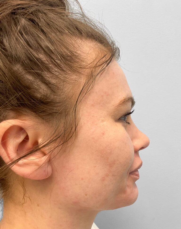 Before Image: Juvederm – Heather - right-side