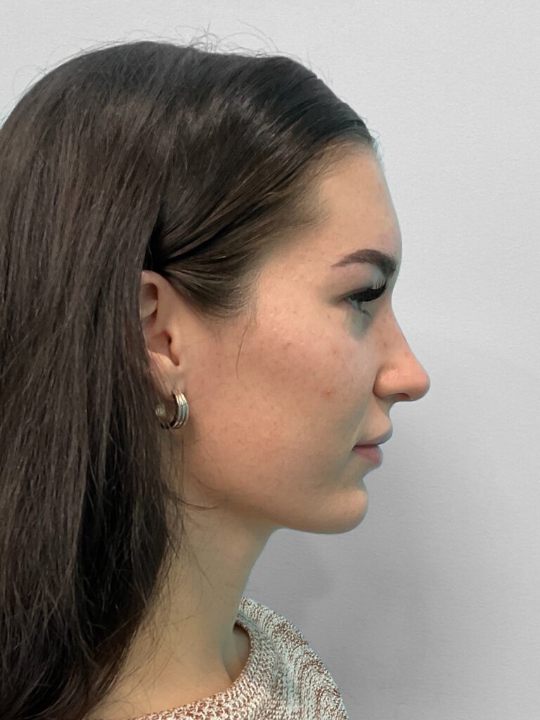 Before Image: Juvederm – Joy - front