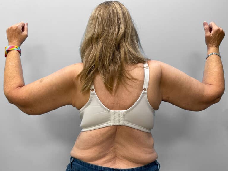 After Image: Arm Lift – Dr. Tucker - back