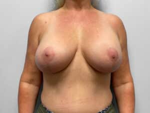 After Image: Breast Augentation with Lift – Dr. Tucker