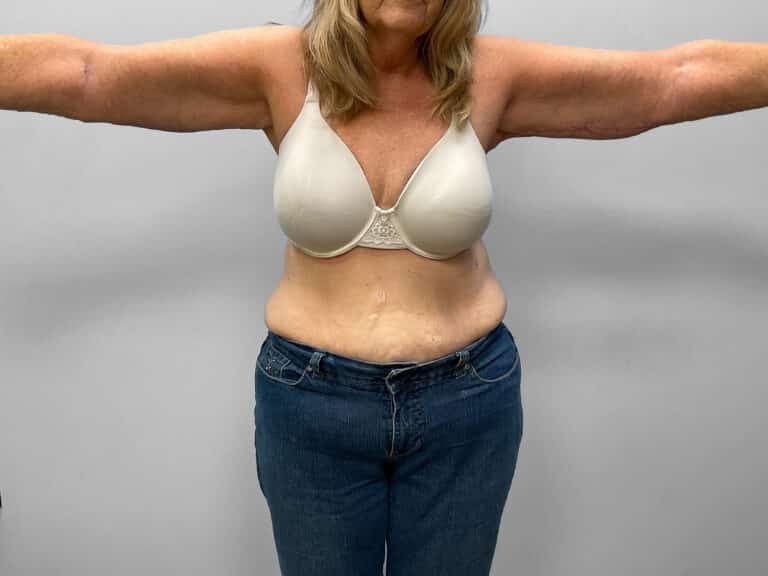 After Image: Arm Lift – Dr. Tucker -