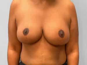 After Image: Breast Reduction – Dr. Howell