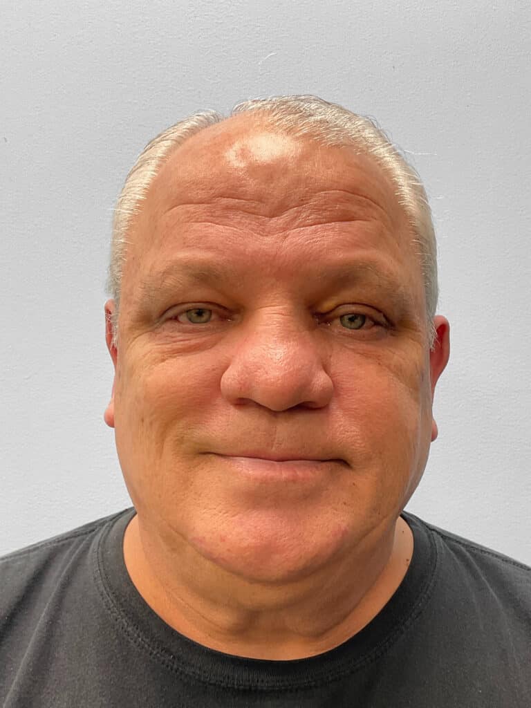 After Image: Blepharoplasty – Dr. Tucker - front