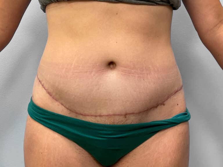 After Image: Abdominoplasty & Liposuction – Dr. Howell - front