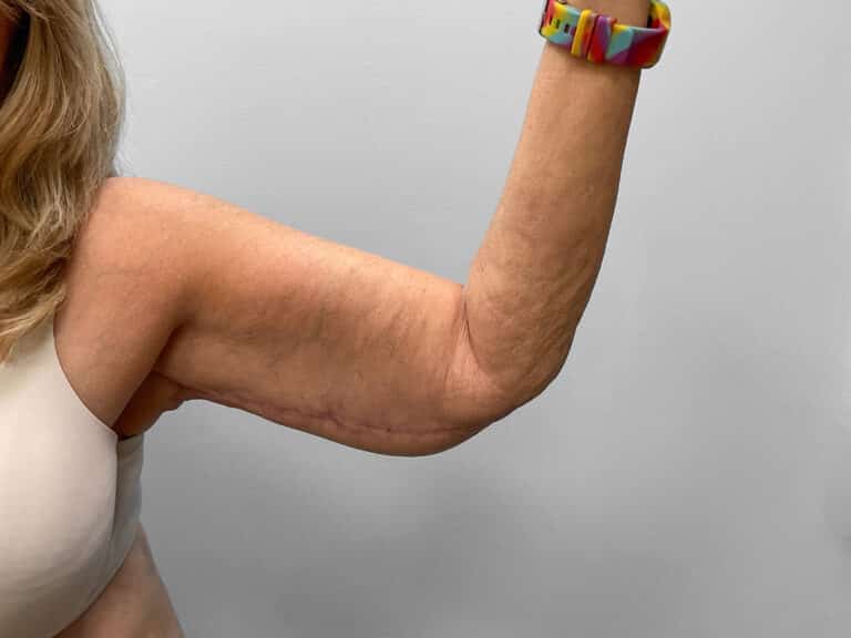 After Image: Arm Lift – Dr. Tucker - left-side