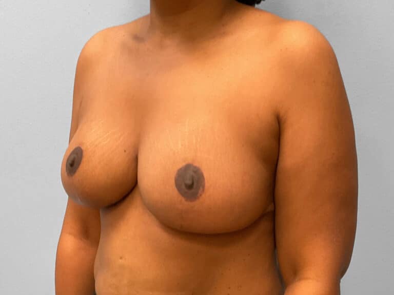 After Image: Breast Reduction – Dr. Howell - left-front-oblique