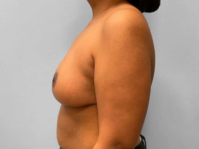 After Image: Breast Reduction – Dr. Howell - left-side