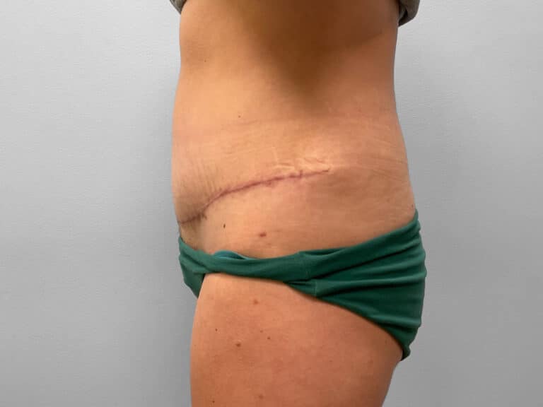 After Image: Abdominoplasty & Liposuction – Dr. Howell - left-side