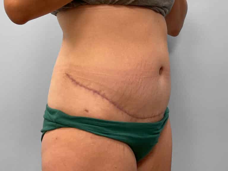After Image: Abdominoplasty & Liposuction – Dr. Howell - right-front-oblique