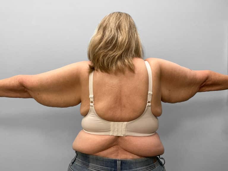 Before Image: Arm Lift – Dr. Tucker - back