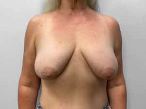 Before Image: Breast Augentation with Lift – Dr. Tucker