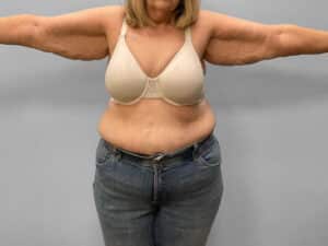 Before Image: Arm Lift – Dr. Tucker