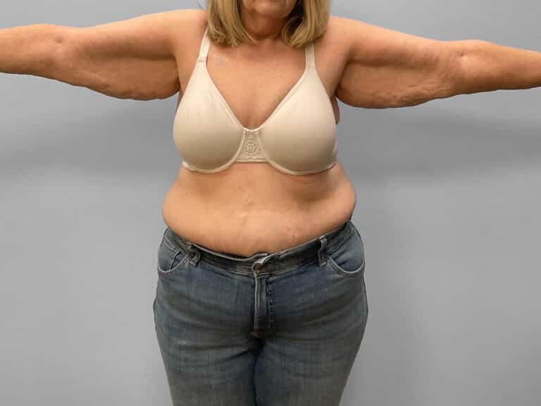 Before Image: Arm Lift – Dr. Tucker -