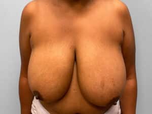Before Image: Breast Reduction – Dr. Howell