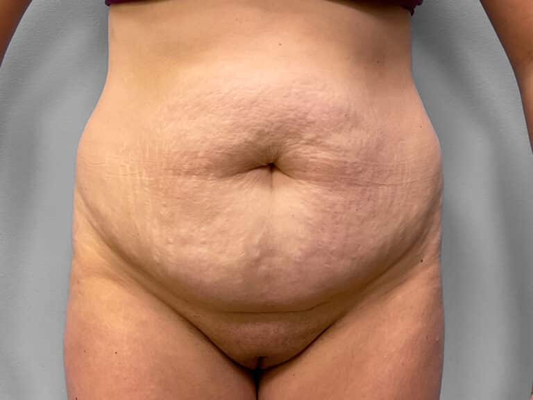 Before Image: Abdominoplasty & Liposuction – Dr. Howell - front