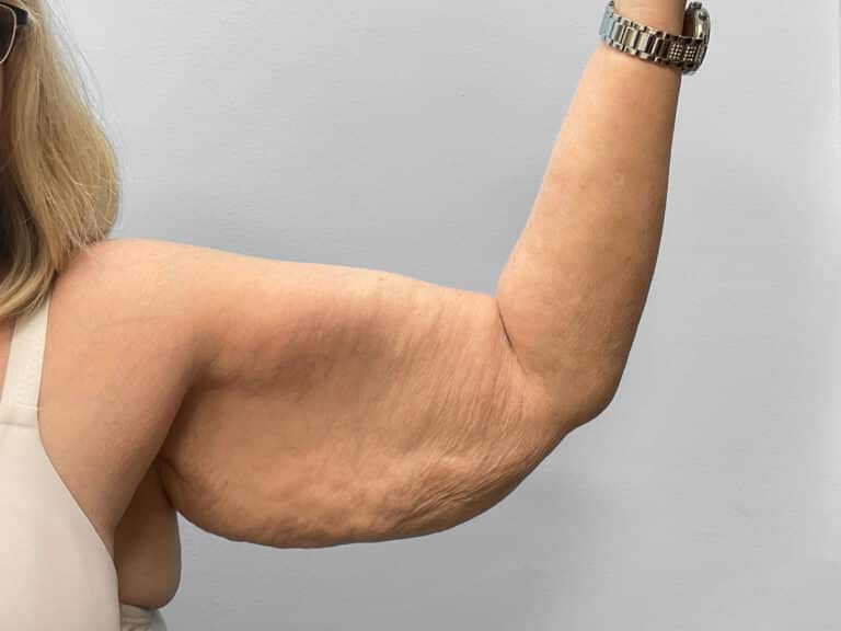 Before Image: Arm Lift – Dr. Tucker - left-side