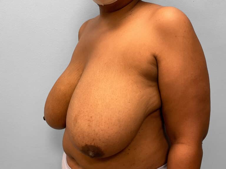 Before Image: Breast Reduction – Dr. Howell - left-front-oblique