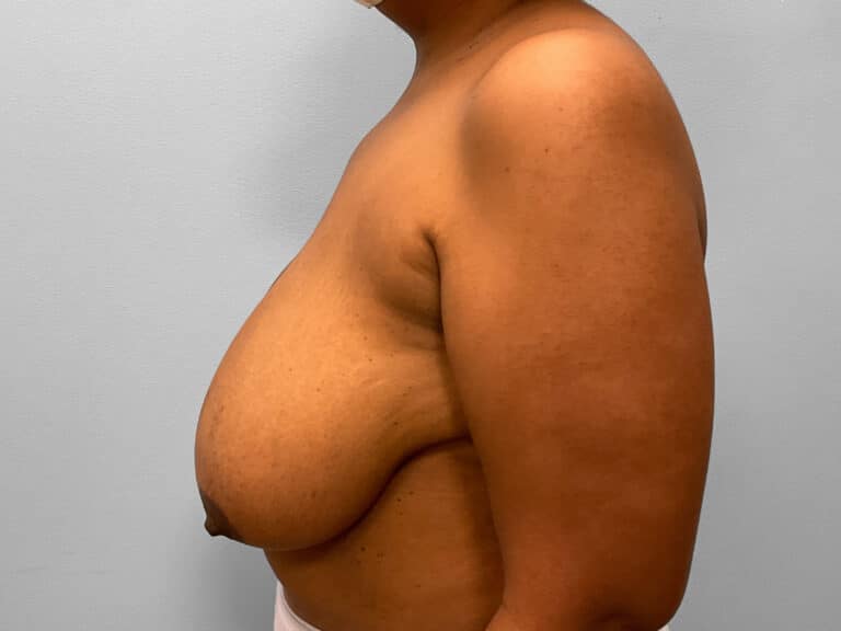Before Image: Breast Reduction – Dr. Howell - left-side