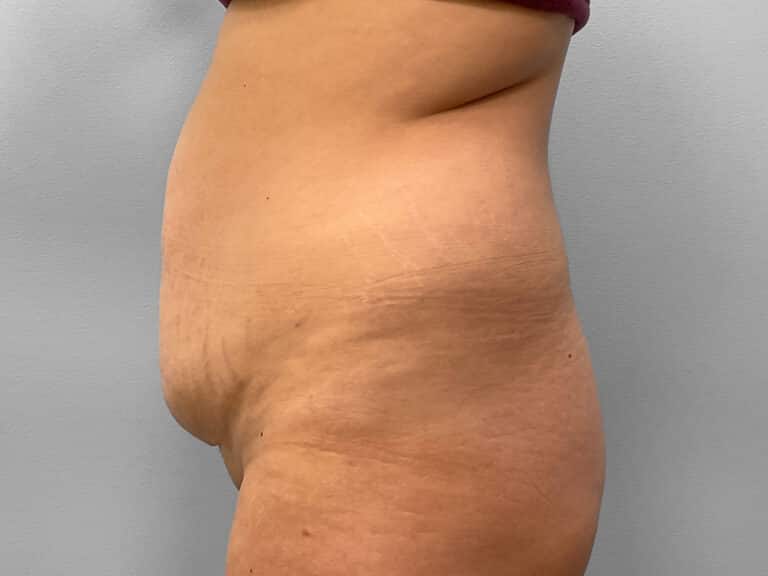 Before Image: Abdominoplasty & Liposuction – Dr. Howell - left-side