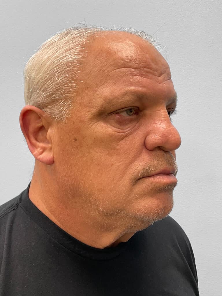 Before Image: Blepharoplasty – Dr. Tucker - right-front-oblique
