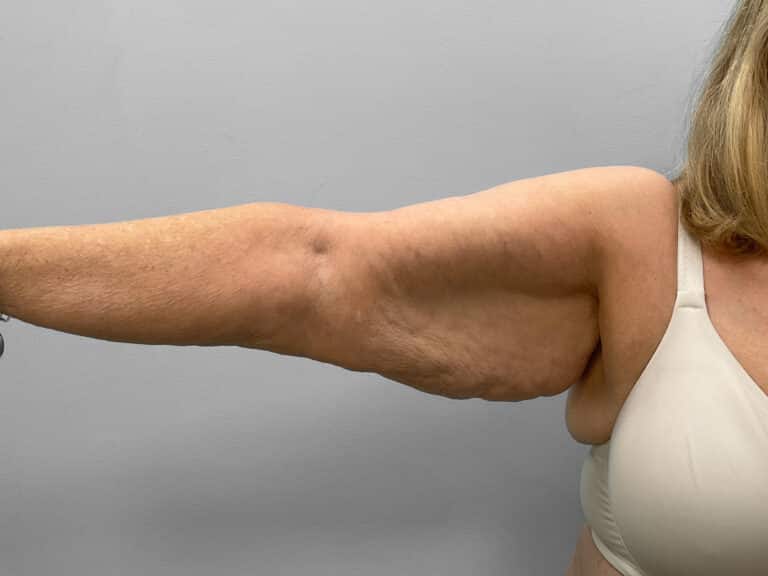 Before Image: Arm Lift – Dr. Tucker - right-side
