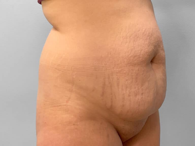 Before Image: Abdominoplasty & Liposuction – Dr. Howell - right-front-oblique