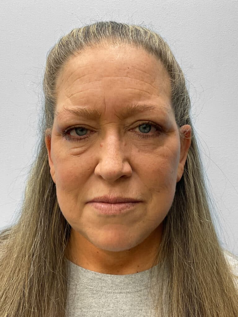 After Image: Facelift & Blehparoplasty -Dr. Tucker - front