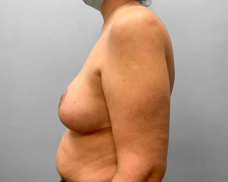 After Image: Breast Reduction – Dr. Howell - left-side
