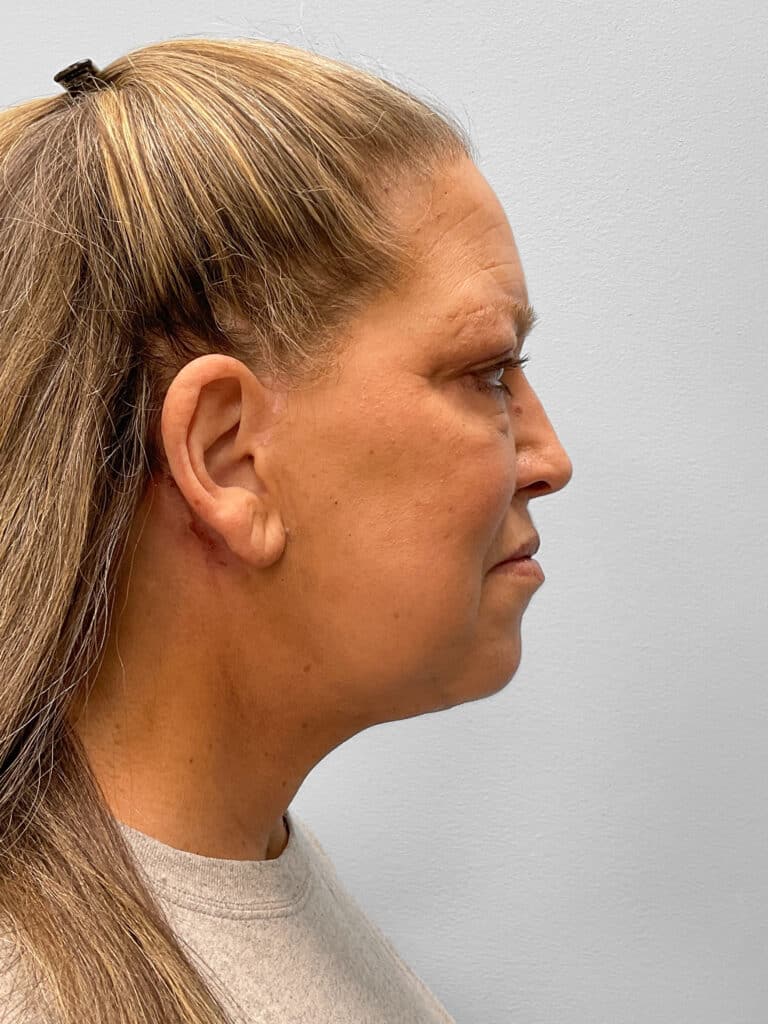 After Image: Facelift & Blehparoplasty -Dr. Tucker - right-side