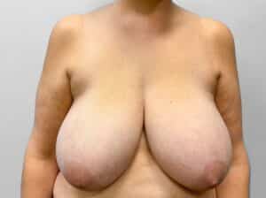 Before Image: Breast Reduction – Dr. Howell