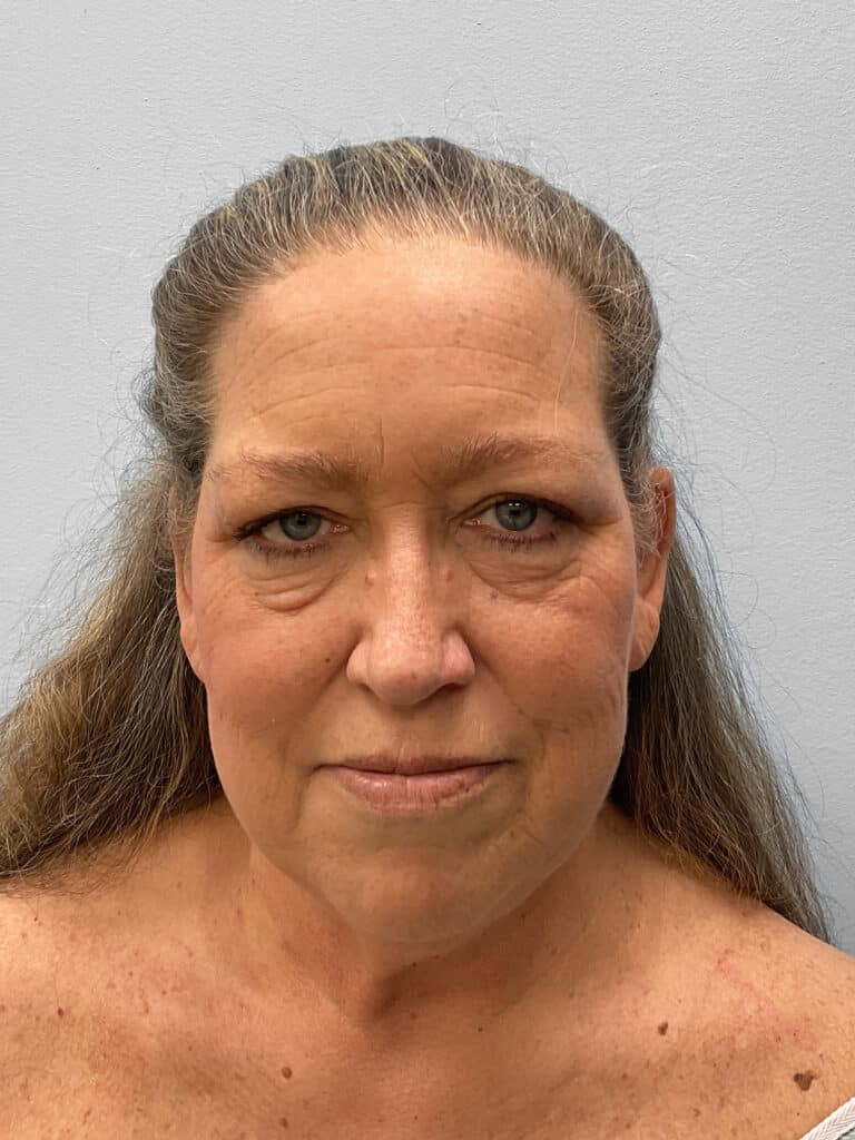 Before Image: Facelift & Blehparoplasty -Dr. Tucker - front