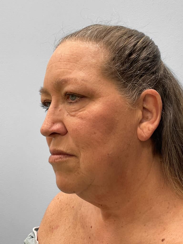 Before Image: Facelift & Blehparoplasty -Dr. Tucker - left-front-oblique