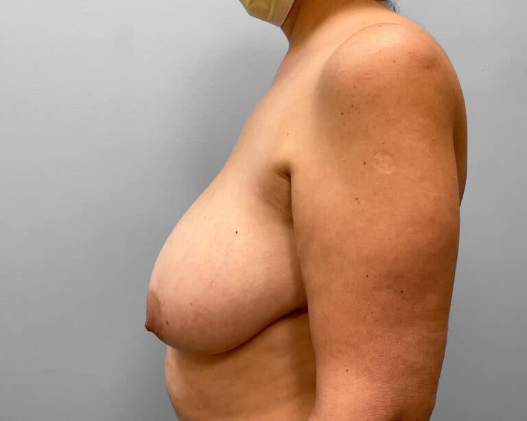 Before Image: Breast Reduction – Dr. Howell - left-side