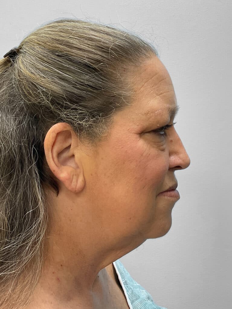 Before Image: Facelift & Blehparoplasty -Dr. Tucker - right-side