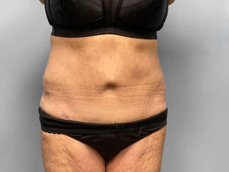 After Image: Tummy Tuck – Dr. Howell - front