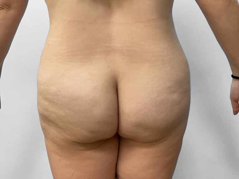 After Image: Tummy Tuck – Dr. Howell - back