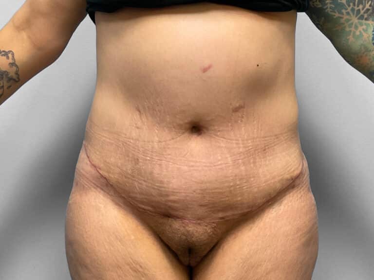 After Image: Abdominoplasty – Dr. Howell - front