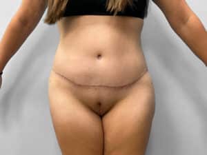 After Image: Tummy Tuck – Dr. Howell