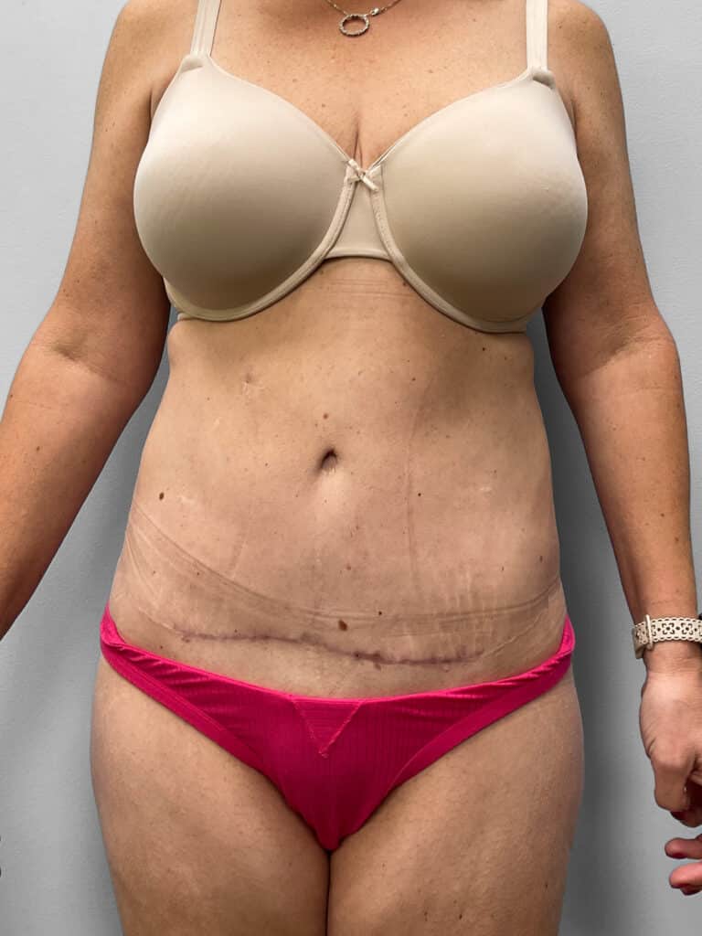 After Image: Mommy Makeover – Dr. Howell - front