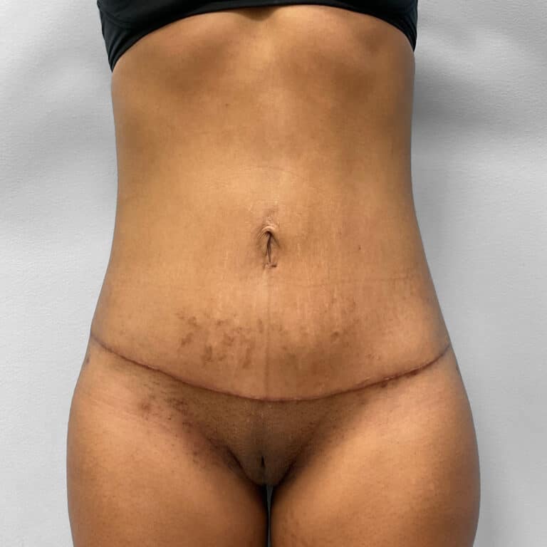 After Image: Umbilical Float Tummy Tuck – Dr. Howell - front