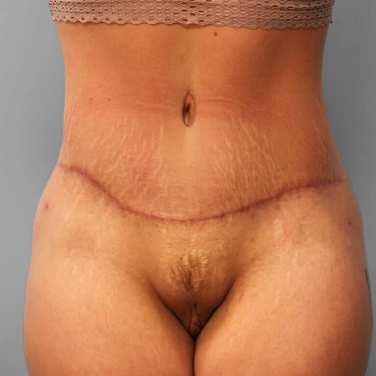 After Image: Abdominoplasty – Dr. Howell - front