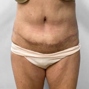 After Image: Abdominoplasty – Dr. Howell