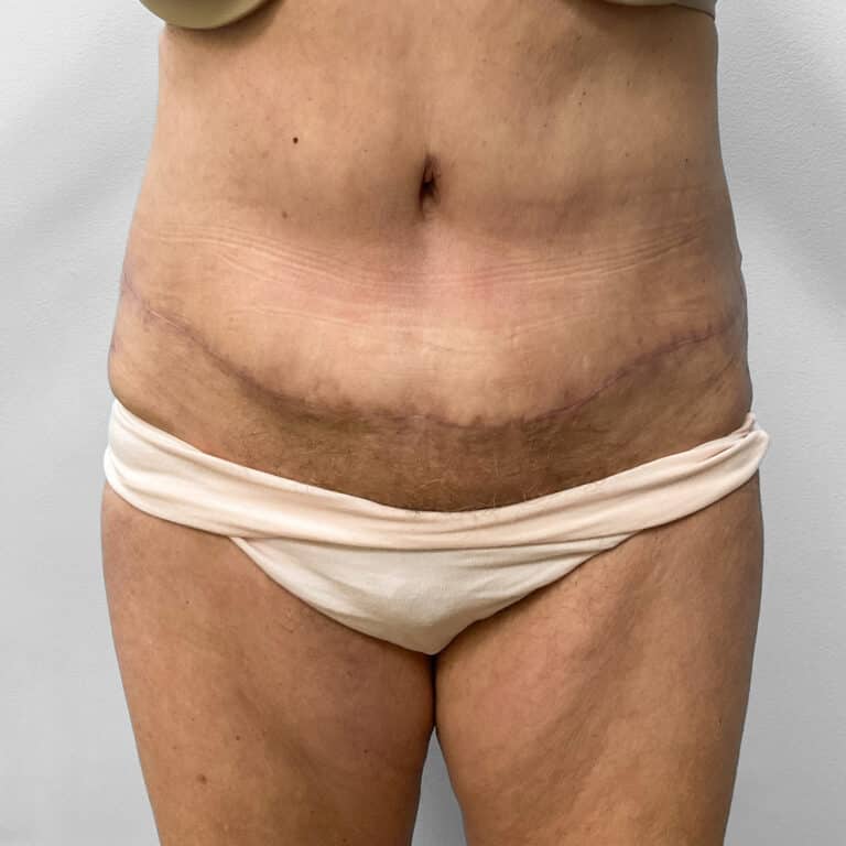 After Image: Abdominoplasty – Dr. Howell - front