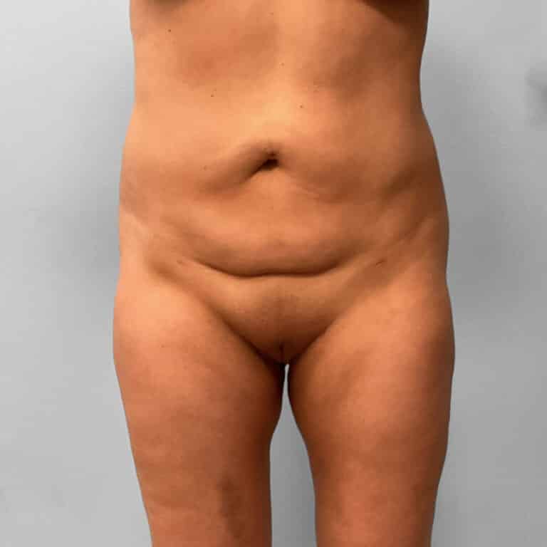 After Image: Liposuction – Dr. Howell - front