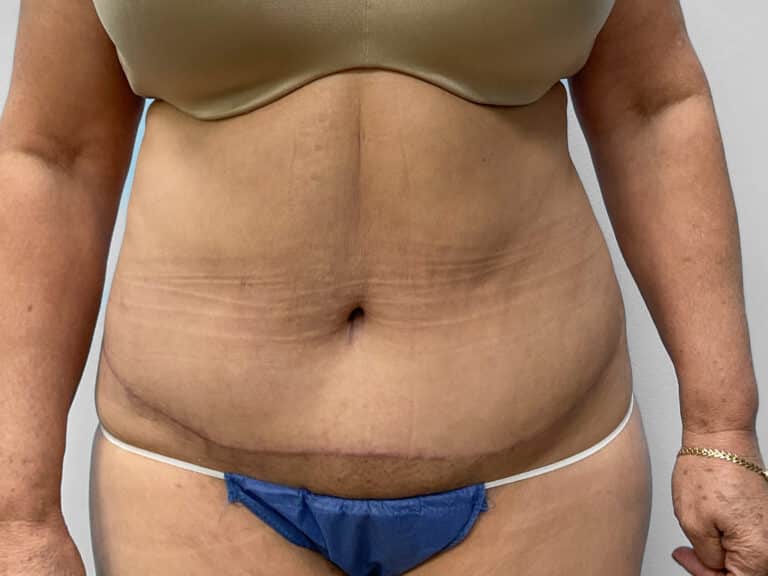 After Image: Abdominoplasty – Dr. Howell - front